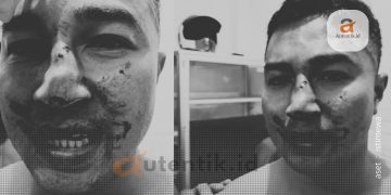 Kondisi Taufik Nur, korban dugaan penganiayaan oleh oknum anggota Polri, Kamis (18/4/2024).