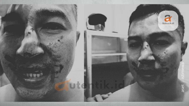 Kondisi Taufik Nur, korban dugaan penganiayaan oleh oknum anggota Polri, Kamis (18/4/2024).